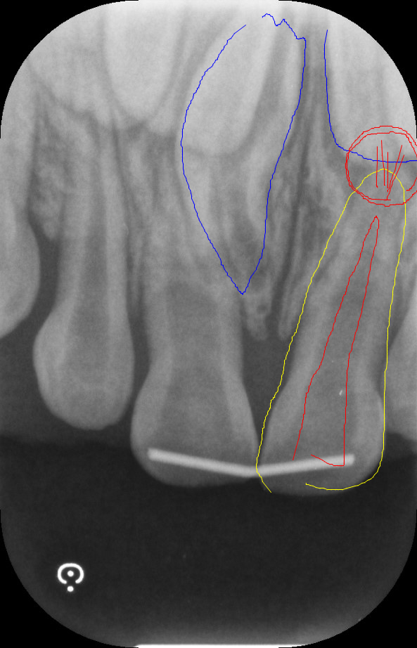 前歯の外傷レントゲン